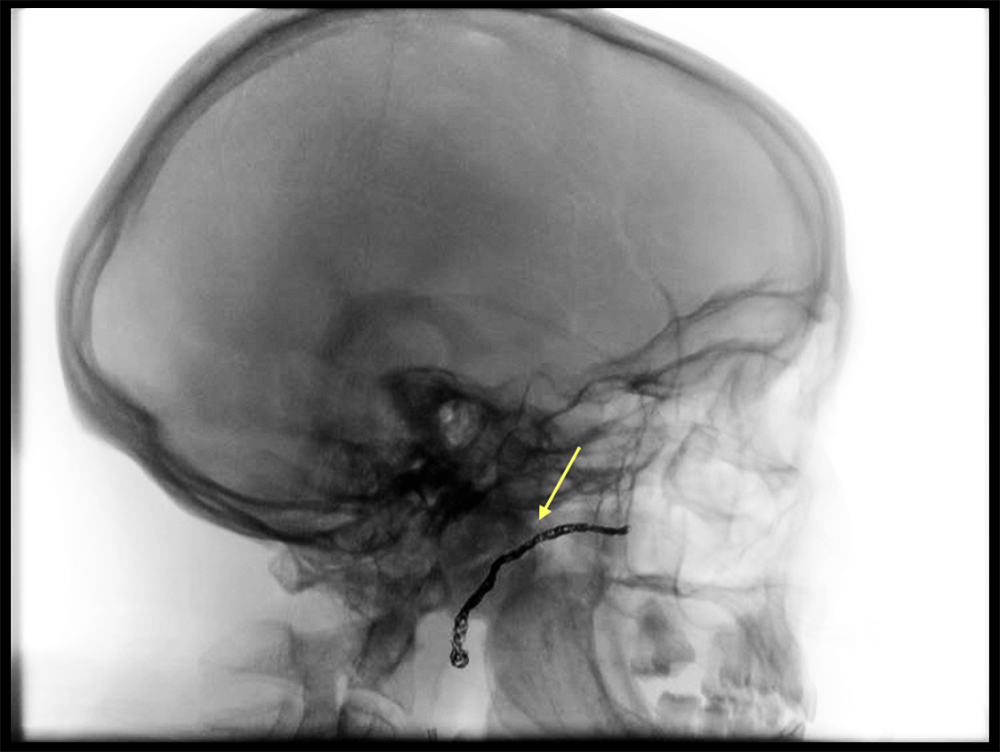 Skull radiograph demonstrating embolization of the maxillofacial artery